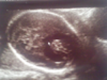Prenatale echografie met de afwezigheid van het corpus callosum