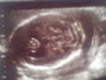 Prenatale echografie met de afwezigheid van het corpus callosum