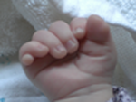 Right hand with exra digit and wide thumb