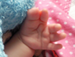 Syndactyly of thumb and finger with visible skin